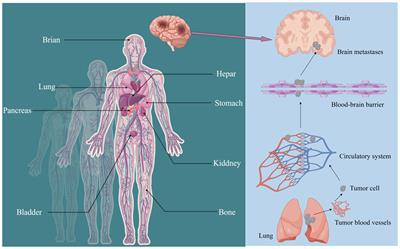 Gastric cancer with brain metastasis: from molecular characteristics and treatment